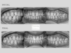 Diastemas y rotaciones severas