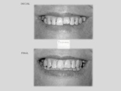 Mordida cruzada anterior SONRISA