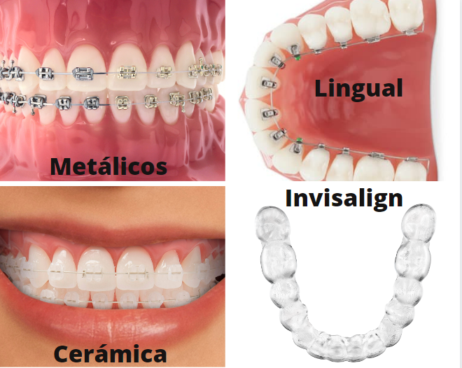 Tipos de ortodoncia