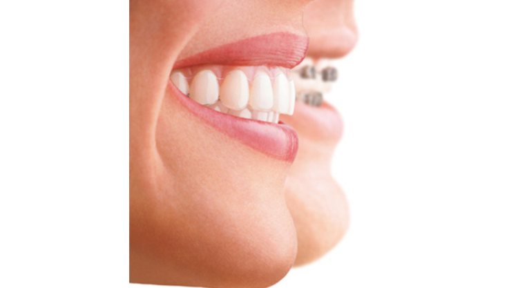 Diferencias entre brackets e invisalign