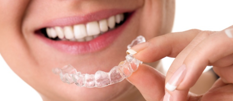 ¿Cuándo se recomienda utilizar o usar Invisalign?