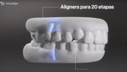 Ventajas de Invisalign Moderate