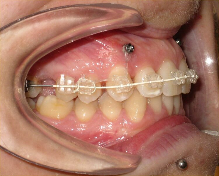 ¿Duelen los microtornillos en ortodoncia?