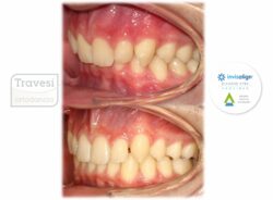 Clase II unilateral con falta de torques lateral dcha