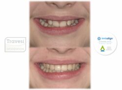 Sobremordida 4 sonrisa